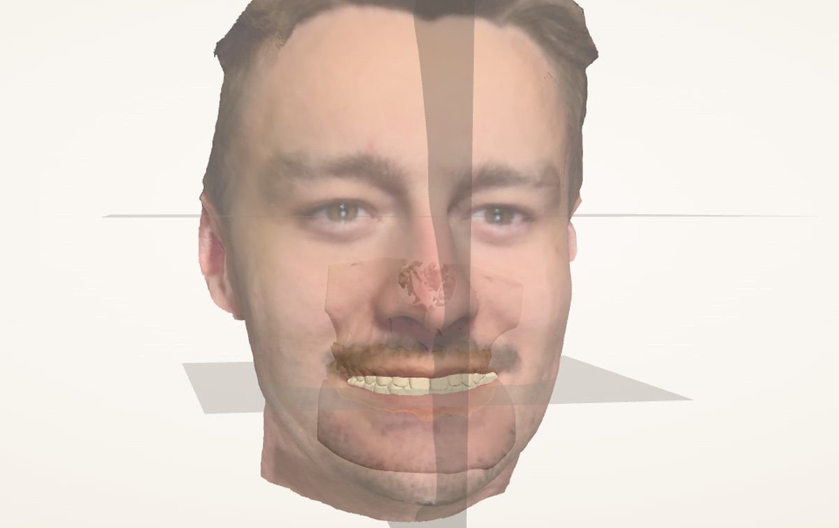 Facescan met CBCT, intraorale scans en referentievlakken